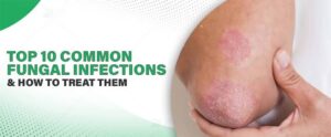 Read more about the article Common Fungal Infection: Symptoms, Treatment & Prevention Tips