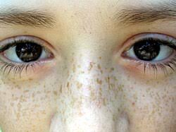 How to Remove Pigmentation, Freckles