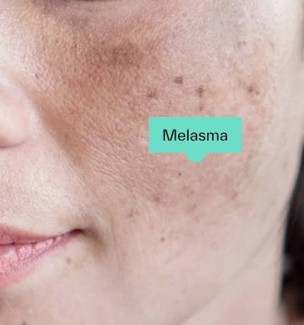 How to remove pigmentation, Melasma