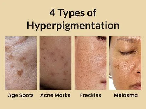 How to remove pigmentation, Hyperpigmentation